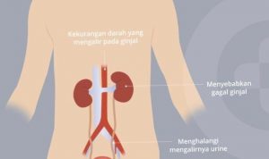 Meski berpotensi fatal, gagal ginjal akut tidak selalu permanen