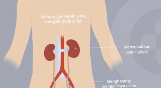 Meski berpotensi fatal, gagal ginjal akut tidak selalu permanen