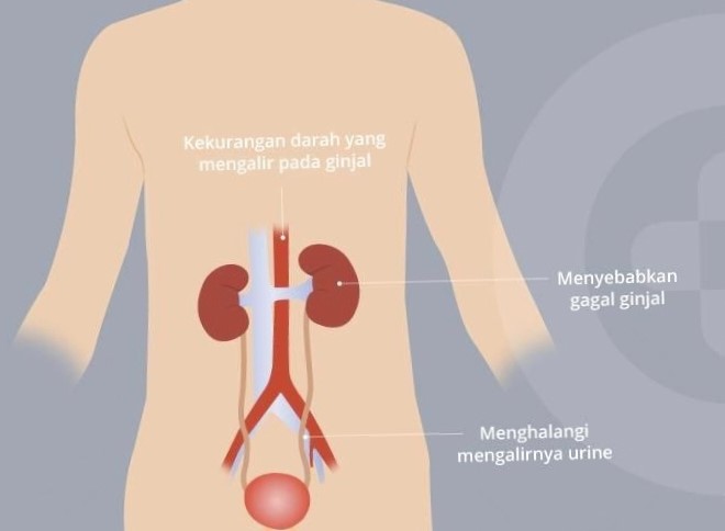 Meski berpotensi fatal, gagal ginjal akut tidak selalu permanen